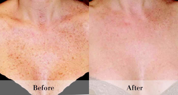 Photo Rejuvenation Before & After