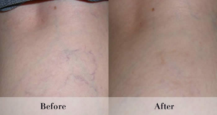 Photo Rejuvenation Before & After