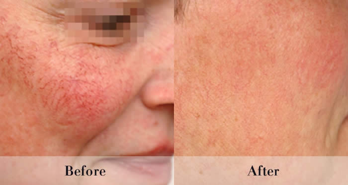 Photo Rejuvenation Before & After