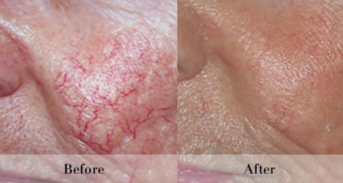 Photo Rejuvenation Before & After