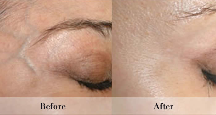 Photo Rejuvenation Before & After