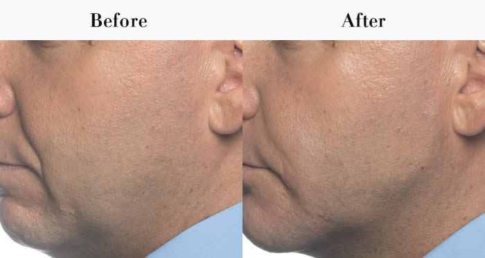 Jawline Definition Before & After