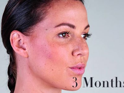 Ultherapy Review