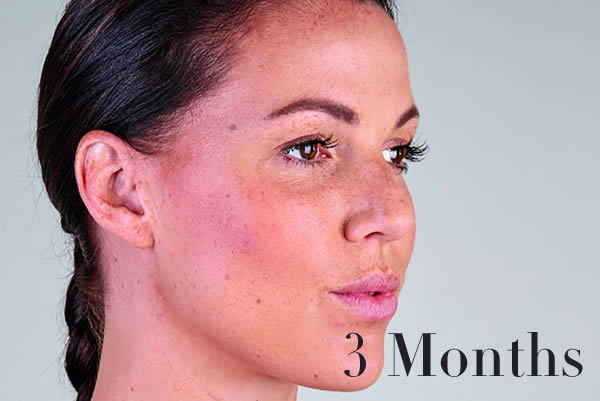 Ultherapy Review
