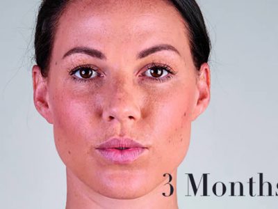 Ultherapy Review