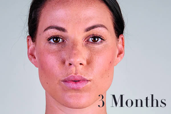 Ultherapy Review