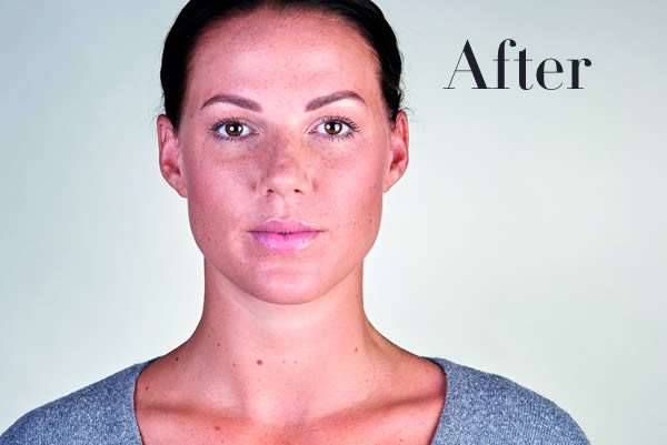 Ultherapy Review