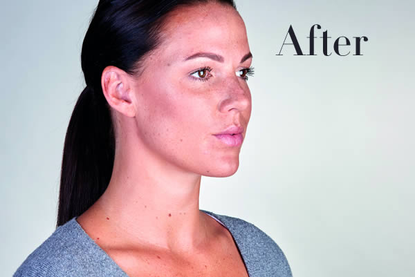 Ultherapy Review