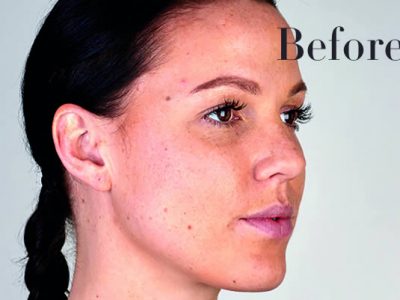 Ultherapy Review