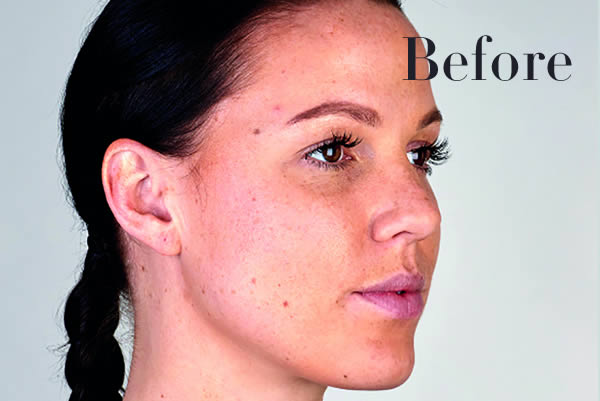 Ultherapy Review