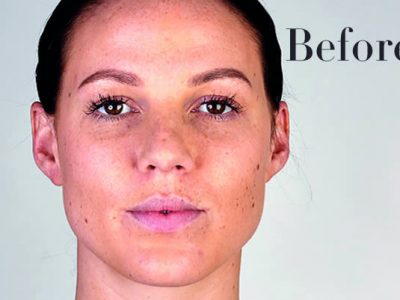 Ultherapy Review