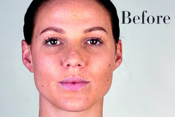 Ultherapy Review