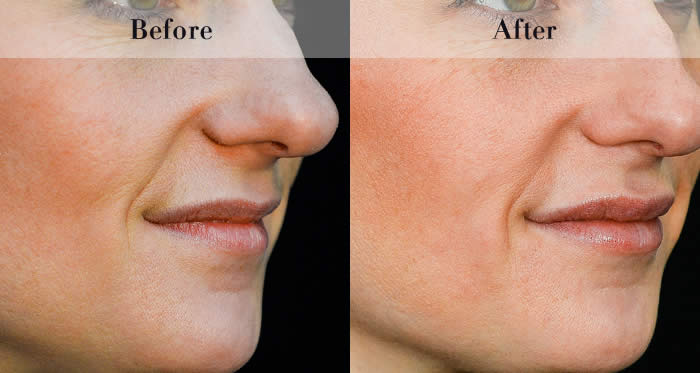 Lip Fillers Before & After