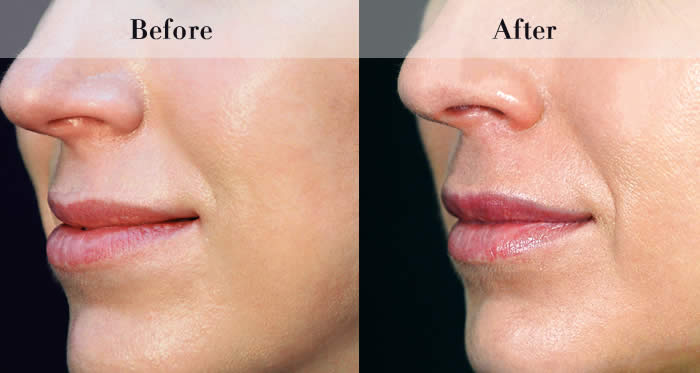 Lip Fillers Before & After