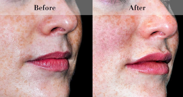 Lip Fillers Before & After