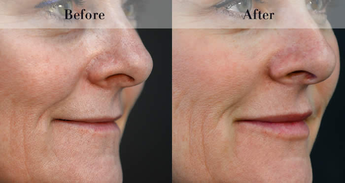 Lip Fillers Before & After