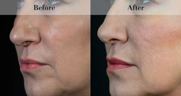 Lip Fillers Before & After