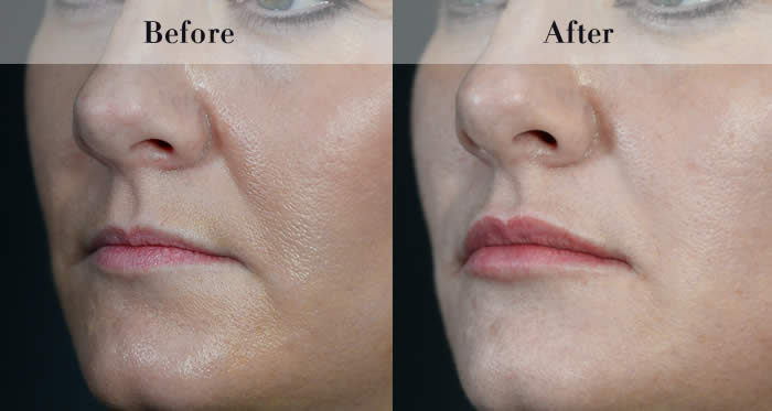 Lip Fillers Before & After