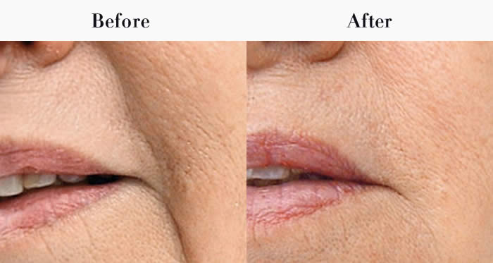 Marionette Lines Before & After