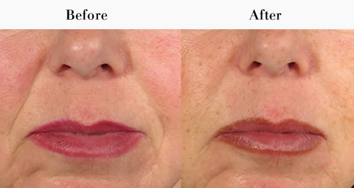 Nasolabial Folds Before & After