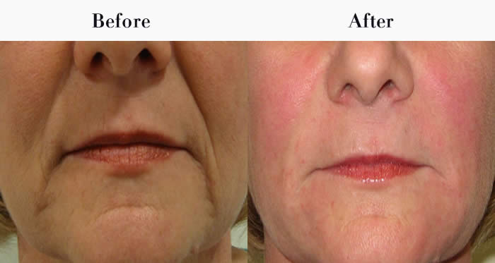Nasolabial Folds Before & After