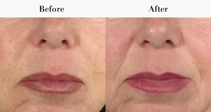 Nasolabial Folds Before & After