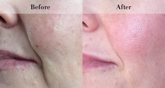 PDO Beauty Threads Before & After