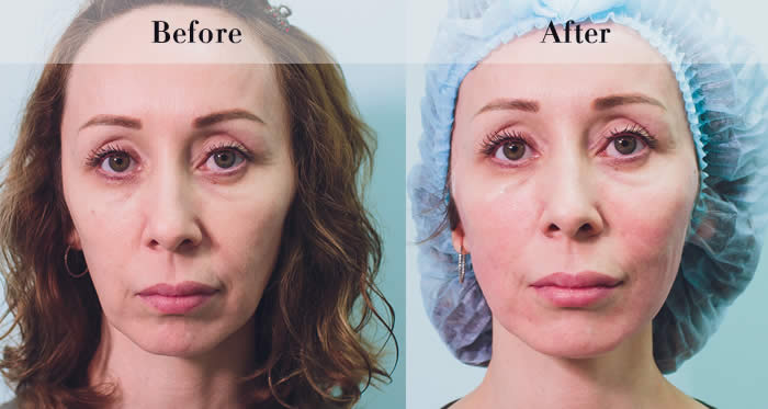 PDO Beauty Threads Before & After