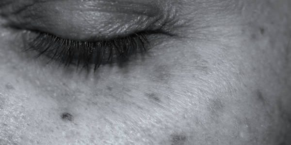 Photrejuvenation