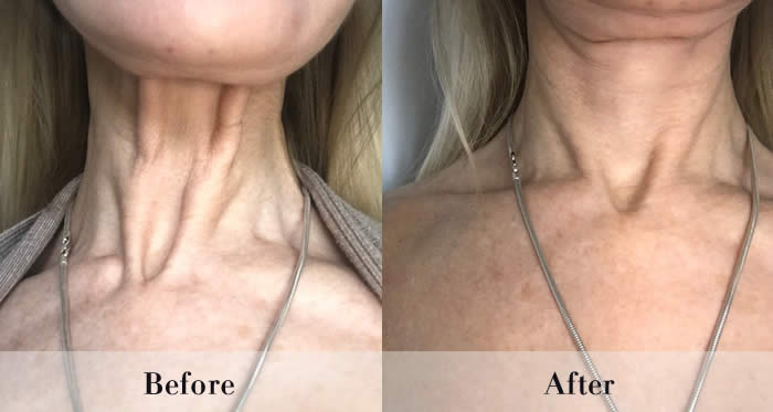 Neck Platysmal Bands Treatment