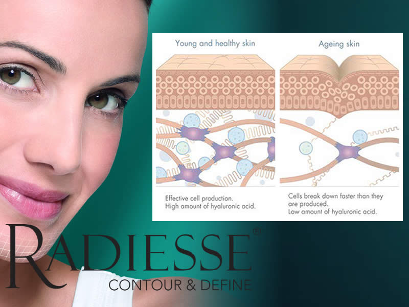Radiasse Hyaluronic Acid Dermal Fillers