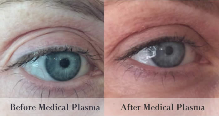 eyelid tightening before and after