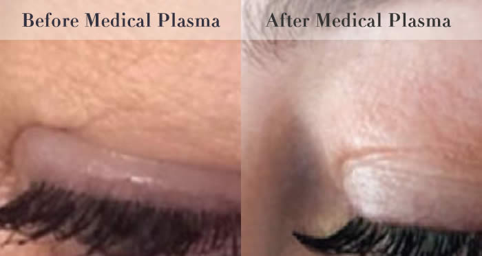 eyelid tightening before and after