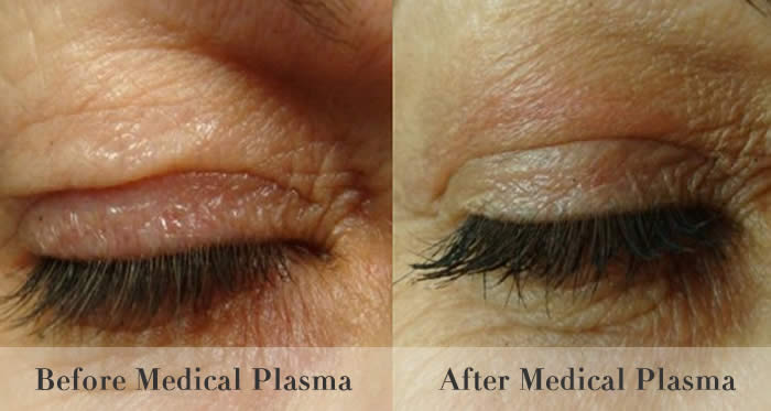 eyelid tightening before and after