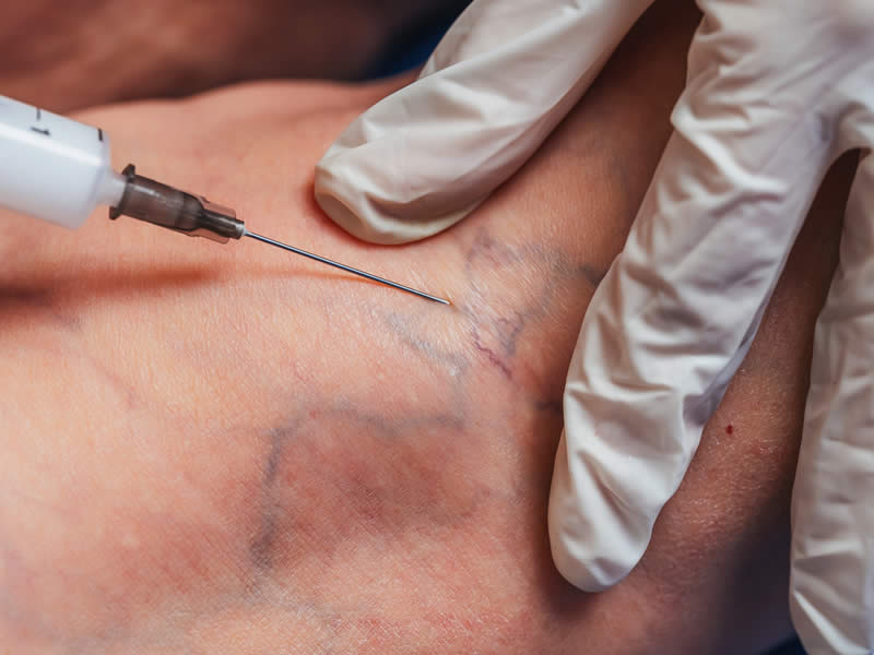 Sclerotherapy