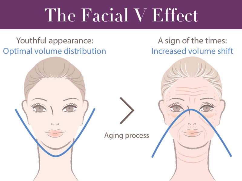 Dermal Filler Face Lift