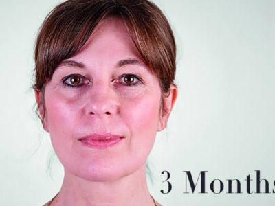 Ultherapy Review 3 Months