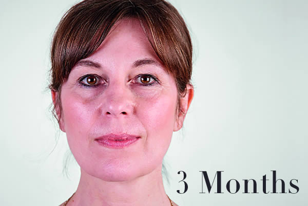 Ultherapy Review 3 Months