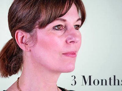 Ultherapy Review 3 Months