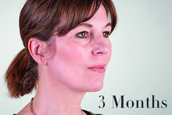 Ultherapy Review 3 Months