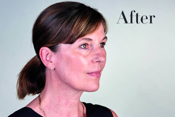 Ultherapy Review After