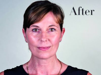 Ultherapy Review After