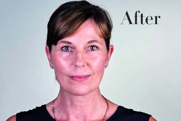 Ultherapy Review After