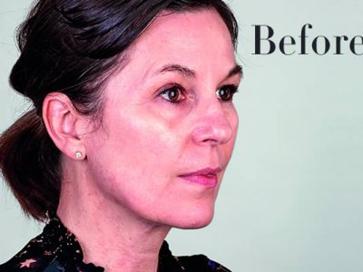 Ultherapy Review Before