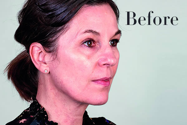 Ultherapy Review Before