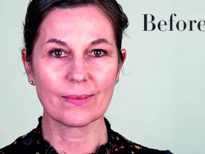 Ultherapy Review Before