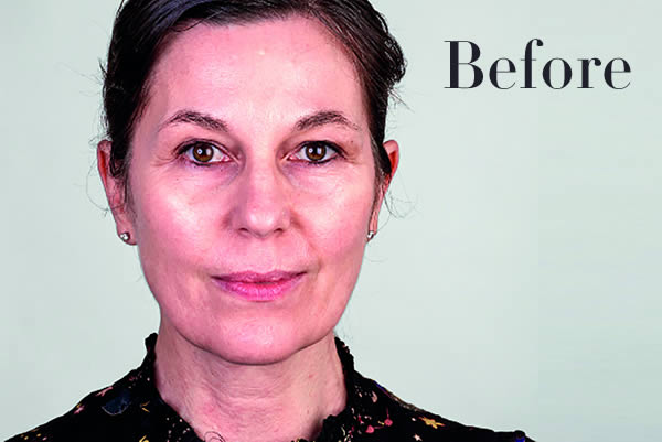 Ultherapy Review Before