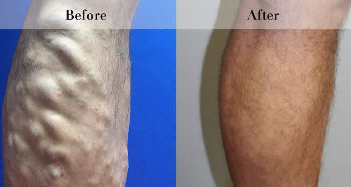 Varicose vein treatment