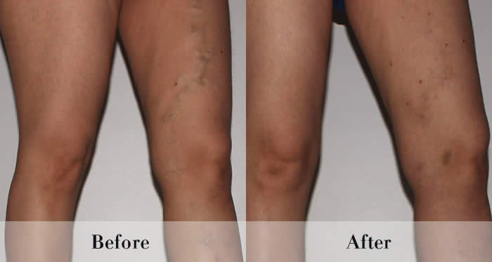 Varicose vein treatment