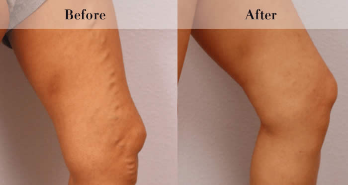 Varicose vein treatment